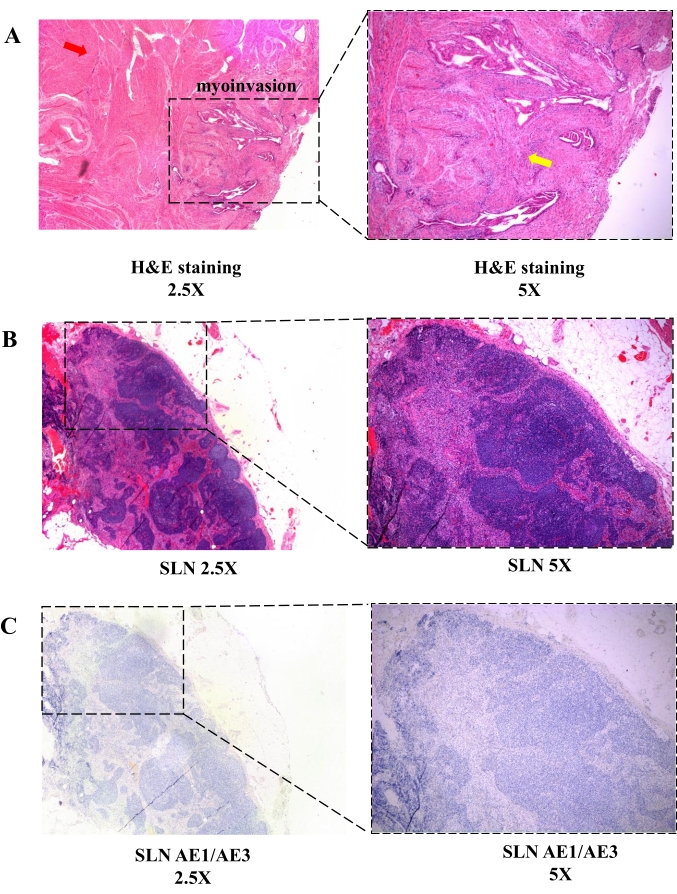 Video: Sentinel Lymph Node Mapping and Biopsy for Endometrial Cancer at ...
