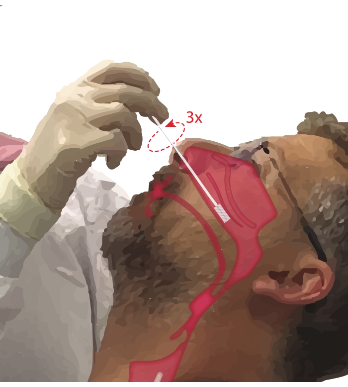 figure-protocol-1 Nasal swab collection diagram; COVID-19 testing method, sample collection procedure.