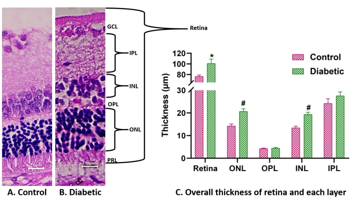 Retinal layer comparison in control vs. diabetic mice; bar graph shows thickness differences.
