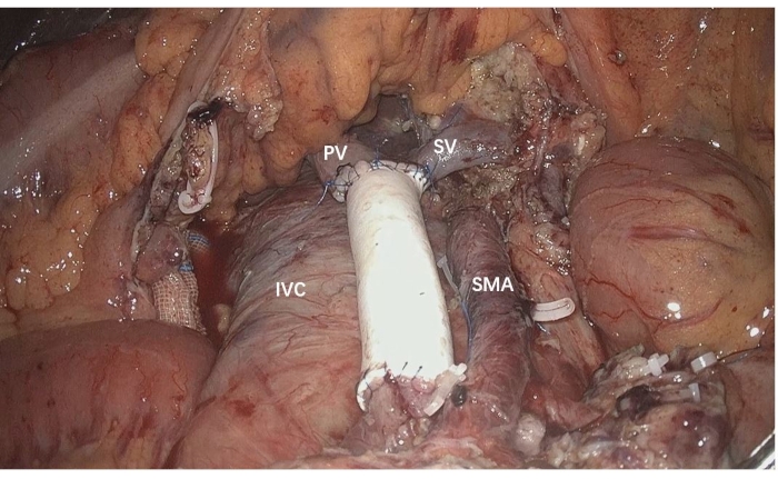 figure-results-4 腹部血管的外科解剖;标注有 PV、SV、IVC、SMA;医学教育图示。