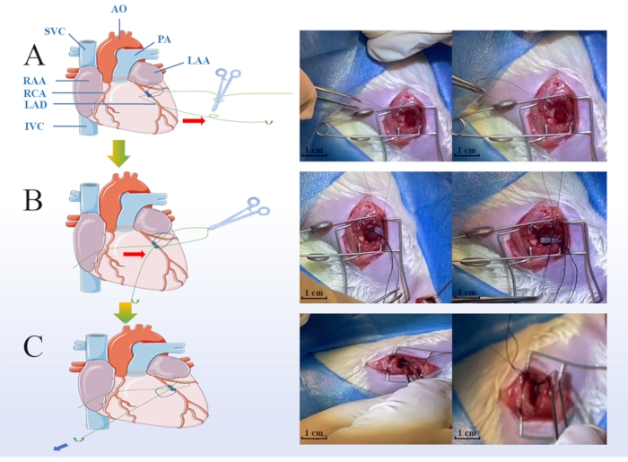Cardiac surgery steps diagram; heart anatomy, surgical process; medical education, hands-on procedure.
