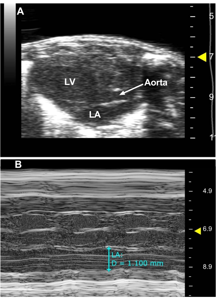 figure-results-2 Cardiac ultrasound diagram; LV, LA, aorta labeled; echocardiography measurement of LA dimensions.