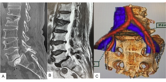 figure-protocol-1 Spinal analysis with CT, MRI, and 3D visualization; A: CT scan, B: MRI, C: 3D reconstruction.