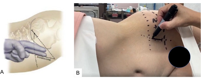 figure-protocol-6 Breast surgery preparation, incision line marked on underarm; medical procedure diagram and setup.