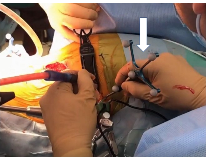 figure-protocol-7 Surgical navigation setup during orthopedic surgery, using trackers for precise instrument positioning.