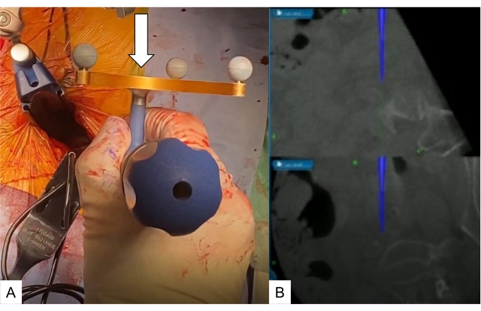 figure-protocol-8 Surgical spinal fixation method; instrumentation setup, CT-guided needle placement diagram.