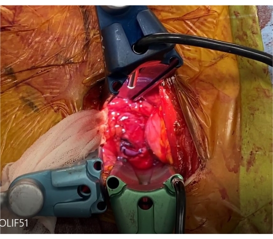 figure-protocol-9 Surgical procedure, spinal fusion, intraoperative view, surgical tools, OLIF approach, medical technique.