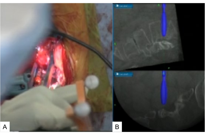 figure-protocol-10 Surgical spinal procedure and fluoroscopy images showing pedicle screw placement technique and monitoring.