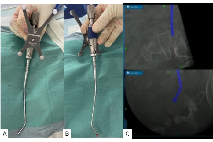 figure-protocol-11 Surgical navigation setup with imaging results; minimally invasive spinal surgery device and x-ray.
