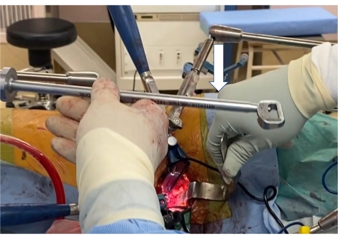 figure-protocol-12 Surgical fixation method; orthopedic procedure; fracture stabilization; medical equipment use.