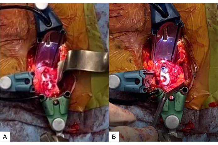 figure-protocol-13 Surgical procedure using retractor in spinal operation setup, emphasizing equipment and incision site.