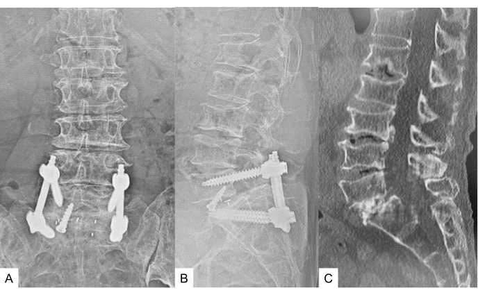 figure-protocol-14 Spinal fixation X-ray images showing surgical implants in lumbar region for stability analysis.