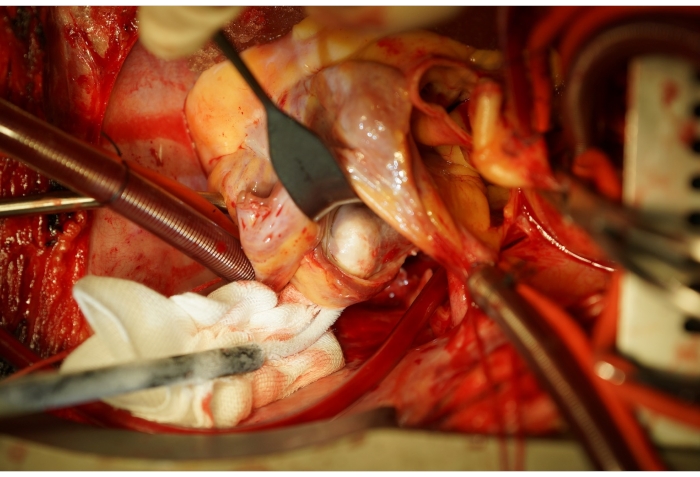 figure-results-2 Cardiac surgery procedure, demonstrating heart tissue and surgical instruments in close-up view.