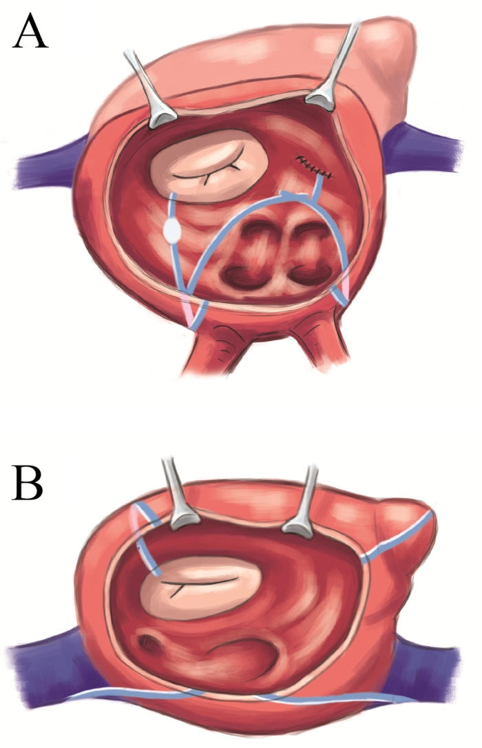 figure-results-3 Heart valve repair illustration, medical diagram, surgical technique, veterinary cardiology.