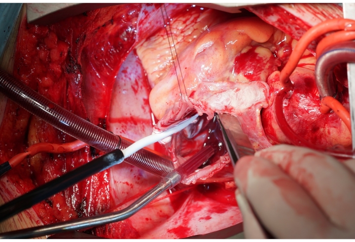 figure-results-4 Surgical procedure showing open-heart surgery setup with tools and blood vessels.