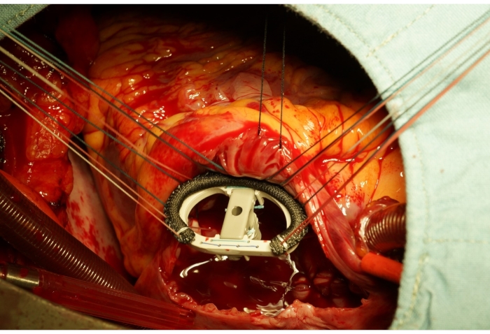 figure-results-6 Cardiac surgery procedure showing heart valve replacement with sutures in surgical setup.