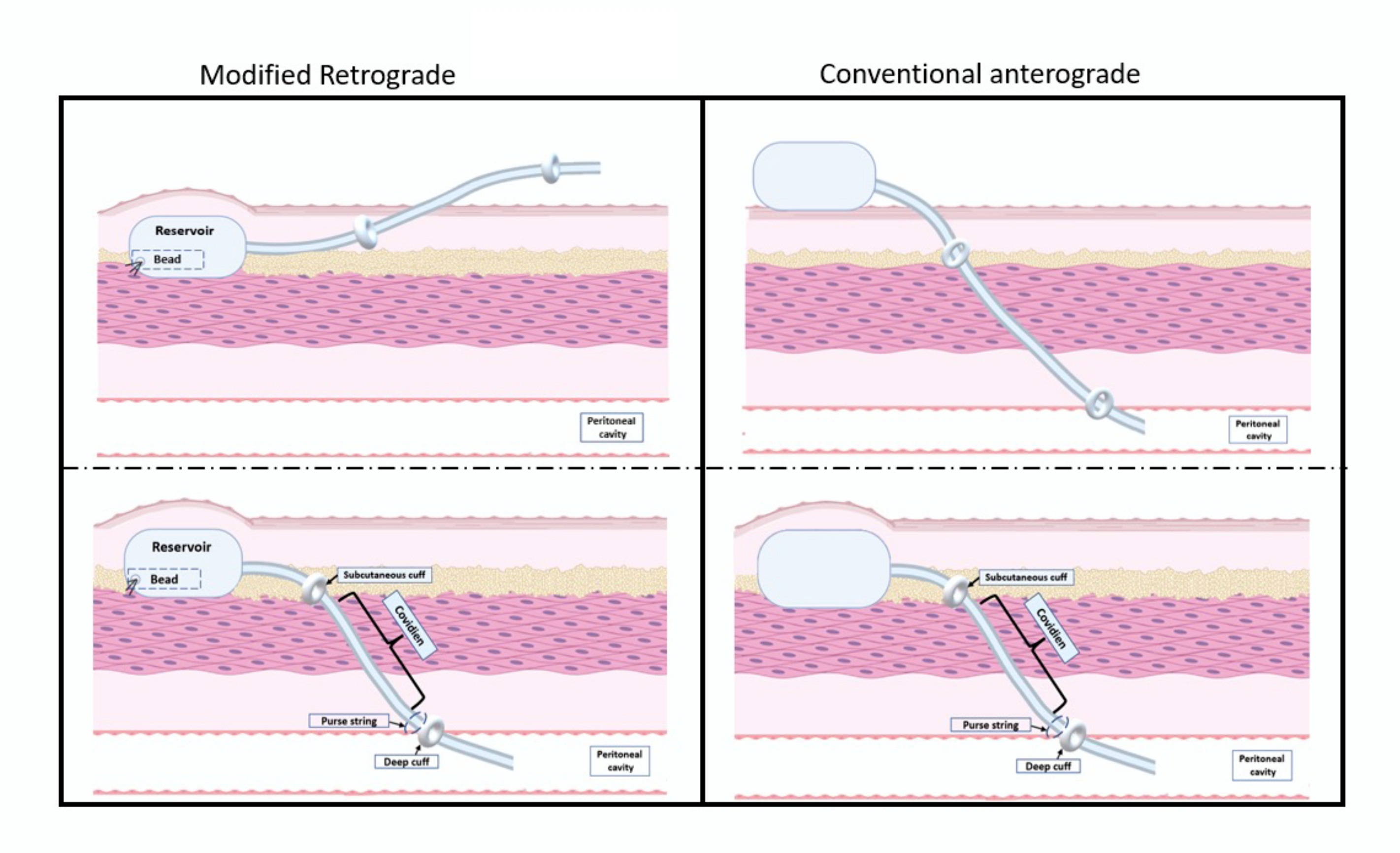 A Retrograde Implantation Approach for Peritoneal Dialysis Catheter ...