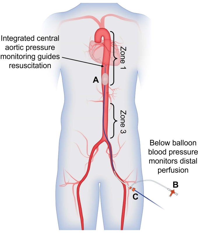 figure-results-1 Schéma de surveillance de la pression aortique pour la réanimation ; zones illustrées ; perfusion centrale et distale notée.