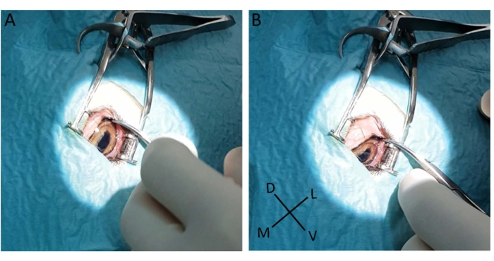 figure-protocol-2 Surgical procedure diagram with ocular dissection, highlighting eye muscle alignment and positioning.