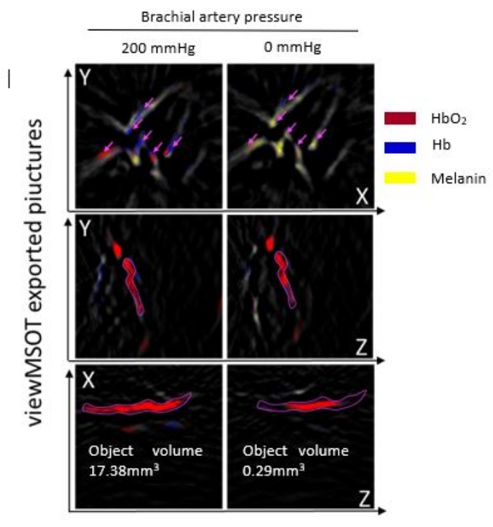 figure-results-2 Brachial artery pressure diagram with HbO2, Hb, melanin analysis; multispectral optoacoustic tomography.