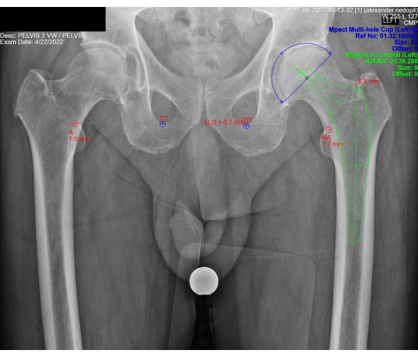 figure-protocol-2 Pelvic X-ray analysis, highlighting femoral measurements and alignment for prosthesis evaluation.