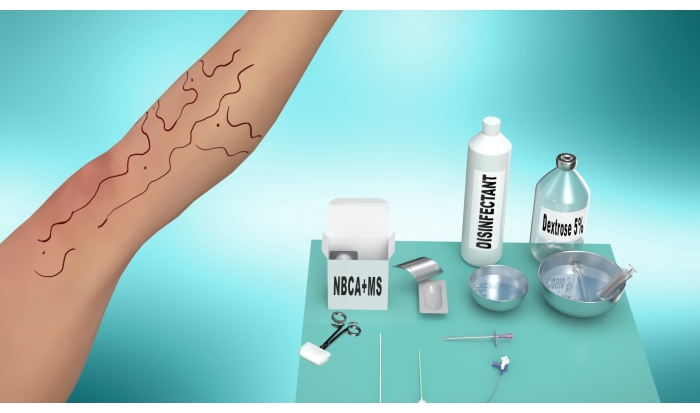Endovenous glue ablation procedure setup, including NBCA+MS, disinfectant, catheters, syringe.
