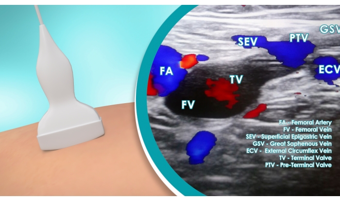 Ultrasound imaging of leg veins; Doppler scan showing femoral artery and vein flow analysis.