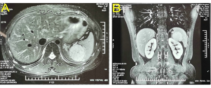 MRI images of abdominal region showing liver and kidney in axial and coronal planes.