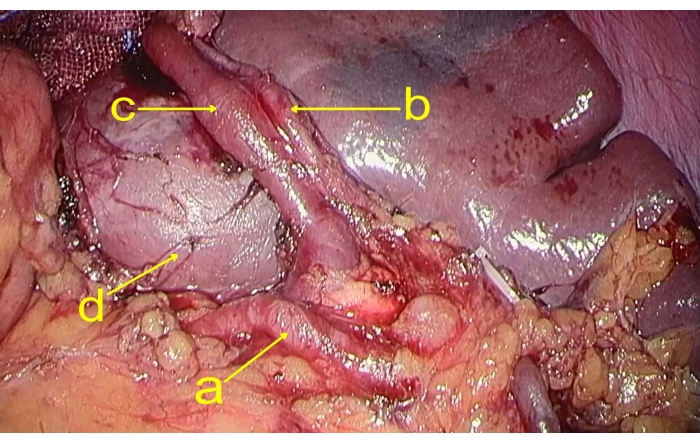 Autonomic nerve dissection diagram shows labeled abdominal structures for surgical reference.
