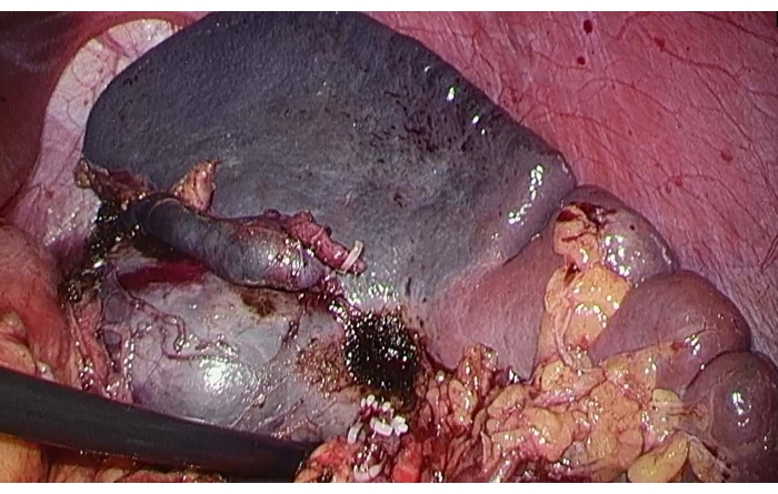 Surgical view of liver with necrosis; clinical diagnosis procedure; medical examination.