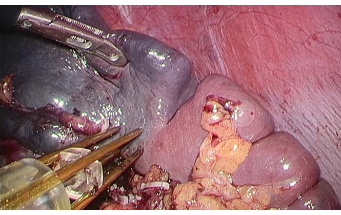 Liver resection surgery view; tools engaging hepatic tissue; surgical procedure; liver anatomy study.
