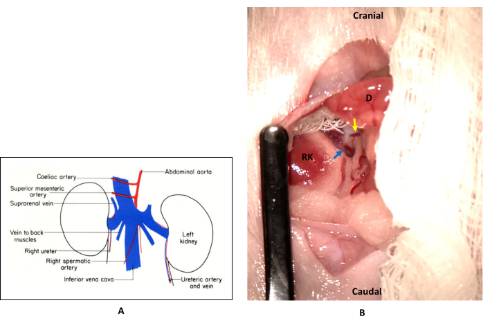 Abdominal anatomy diagram and surgical setup; kidney and arteries labeled; educational reference.