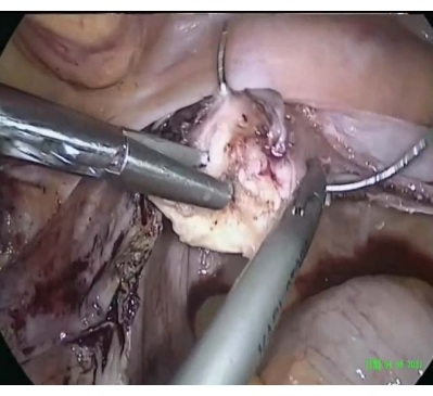 Surgical procedure, laparoscopic instruments in tissue removal, medical operation technique.