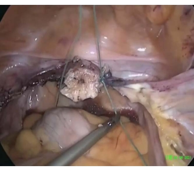 Surgical procedure; endoscopic view, tissue excision, laparoscopic technique, medical operation.