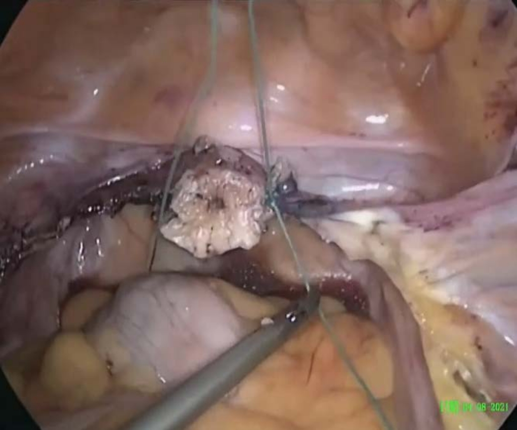 Laparoscopic Non-Mesh Cerclage Pectopexy for Pelvic Organ Prolapse