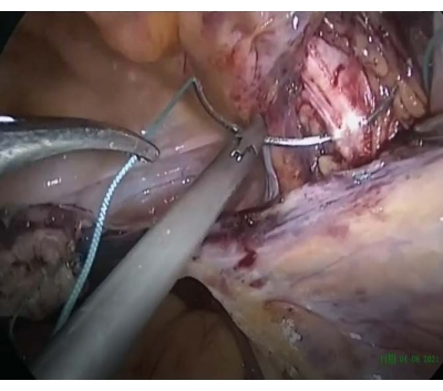 Laparoscopy procedure, surgical equipment, minimally invasive surgery, medical operation technique.