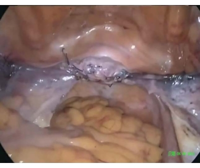 Surgical site after gastrointestinal procedure, showing sutures and tissue; endoscopic image.