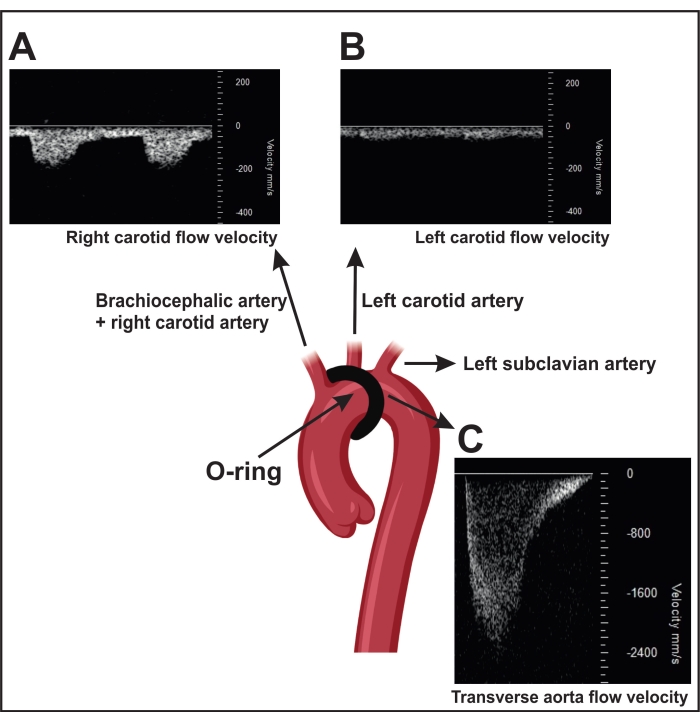 Arterial flow velocity; Doppler ultrasound graphs and aortic diagram; cardiovascular study analysis.