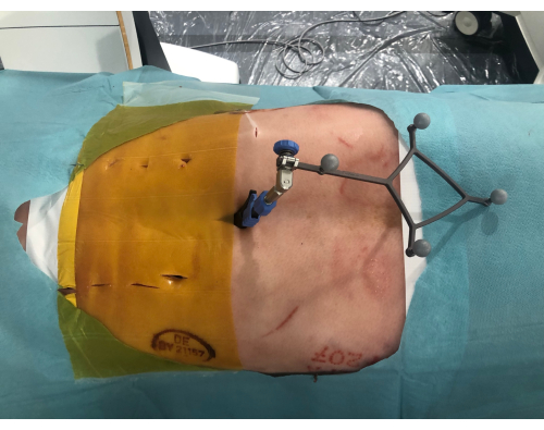 Surgical setup with stereotactic frame on skin; procedure precision, operating room equipment.