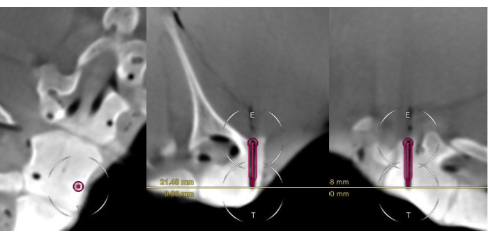 Dental CT scan analysis, measurement comparison for implant planning, jawbone cross-section diagram.