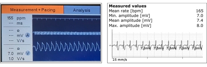figure-results-3 Cardiac pacing telemetry; ECG waveforms; data analysis; heart rate, amplitude metrics; graph.