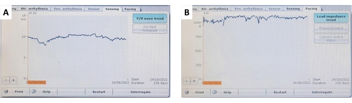 figure-results-9 P/R wave trend and lead impedance trend charts, cardiac data analysis, electrophysiological study.