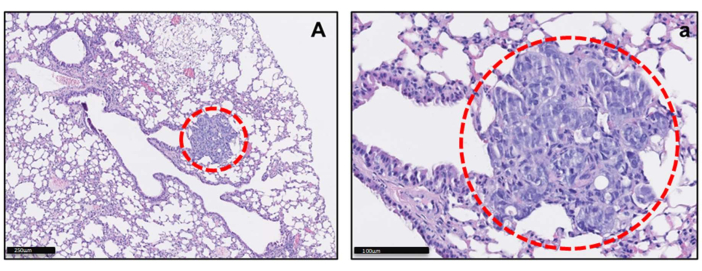 Lung tissue microscopy, histological slide, cellular structure, red circle highlights anomaly.