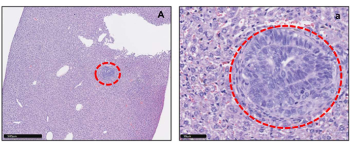 Histology section, tissue analysis. Microscope image highlights cell structure, abnormal cell cluster.