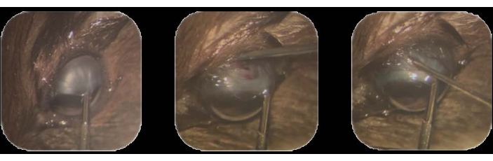 figure-protocol-1 eye surgery procedure; sequence of steps for intraocular lens insertion; surgical method; ophthalmology
