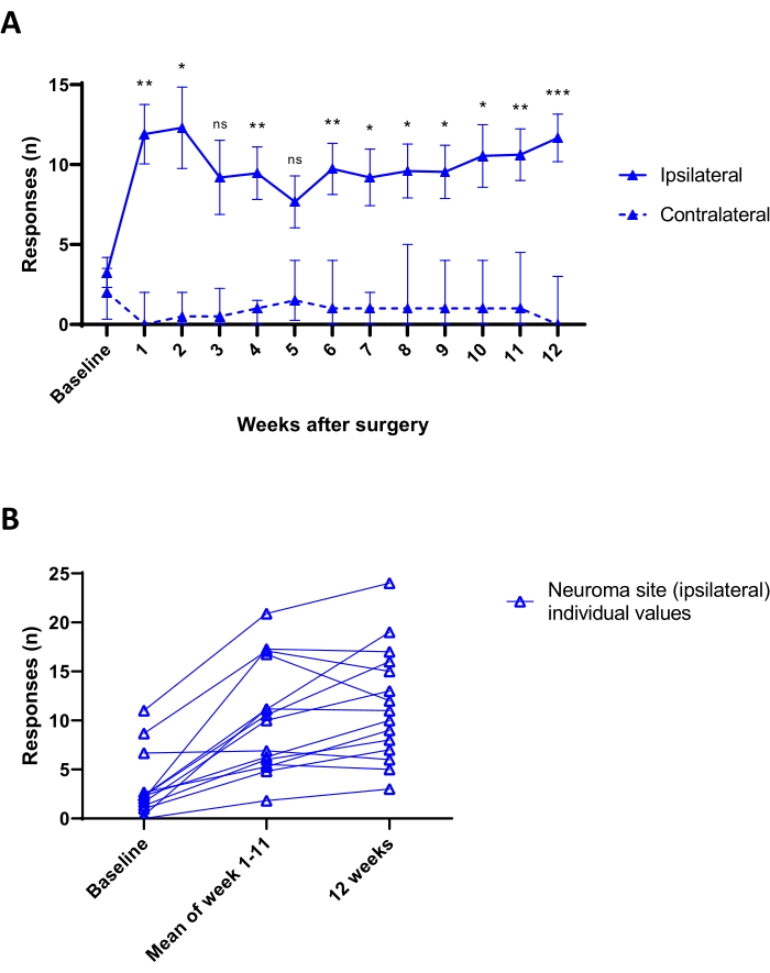 Graph of nerve response post-surgery, comparing ipsilateral vs. contralateral over 12 weeks.