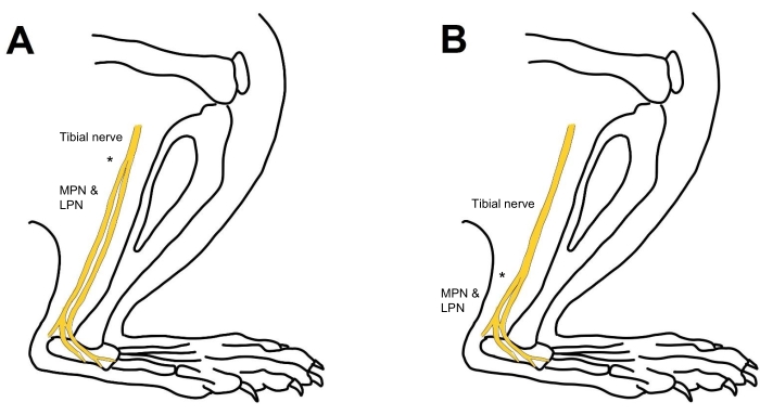 Tibial nerve diagram; anatomy comparison, MPN & LPN nerves, leg nerves, educational illustration.