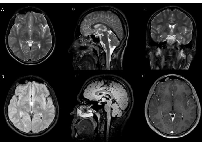 Brain MRI scans, multiple views for anatomical study, axial, sagittal, coronal orientation analysis.