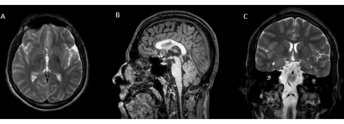 MRI scan showing axial, sagittal, and coronal brain sections for anatomical analysis.