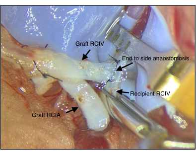 Grafting procedure, artery anastomosis, microscope image, vascular surgery technique.